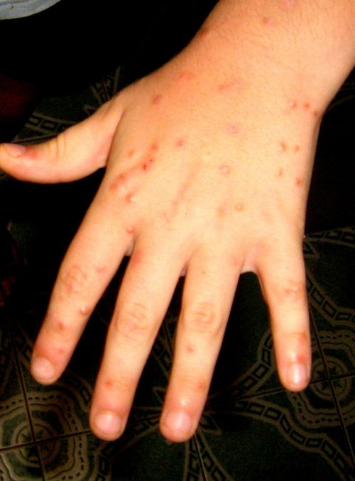 Tipiche lesioni bollose prodotte da una microscopica formica aculeata del genere Solenopsis in un bambino.